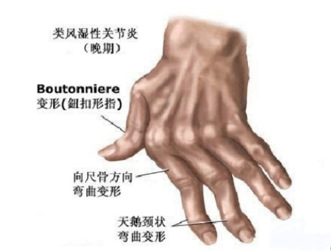 类风湿性关节炎 拷贝.jpg