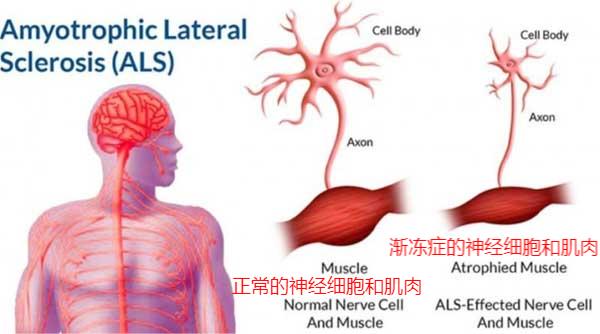 渐冻症患者有望解冻？Relyvrio能成功延长生存期(图1)
