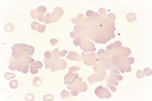 冷凝集素病中的红细胞聚集.jpg