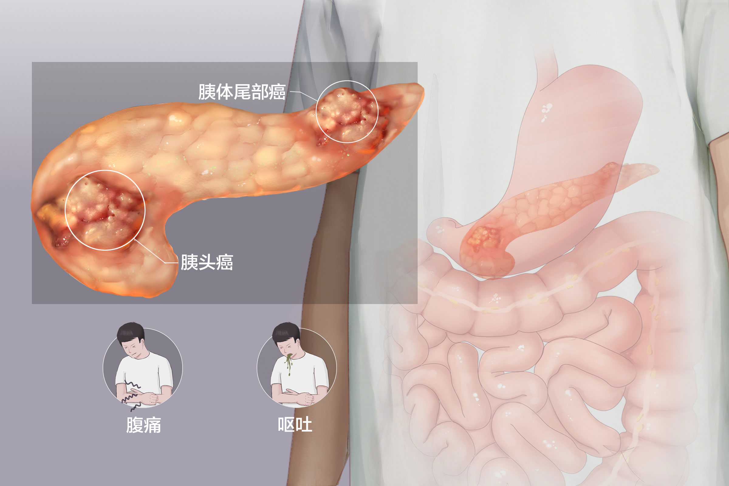 尼妥珠单抗获批新适应症！靶向打击胰腺癌，死亡风险降低50%(图2)