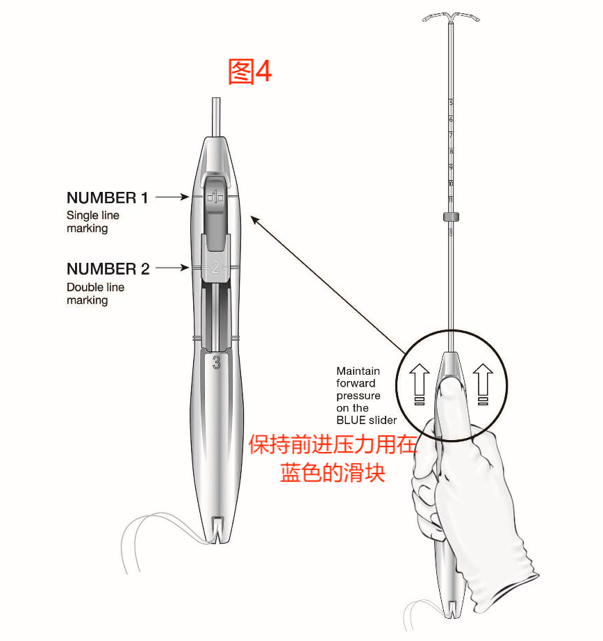 宫内节育器Liletta(图5)