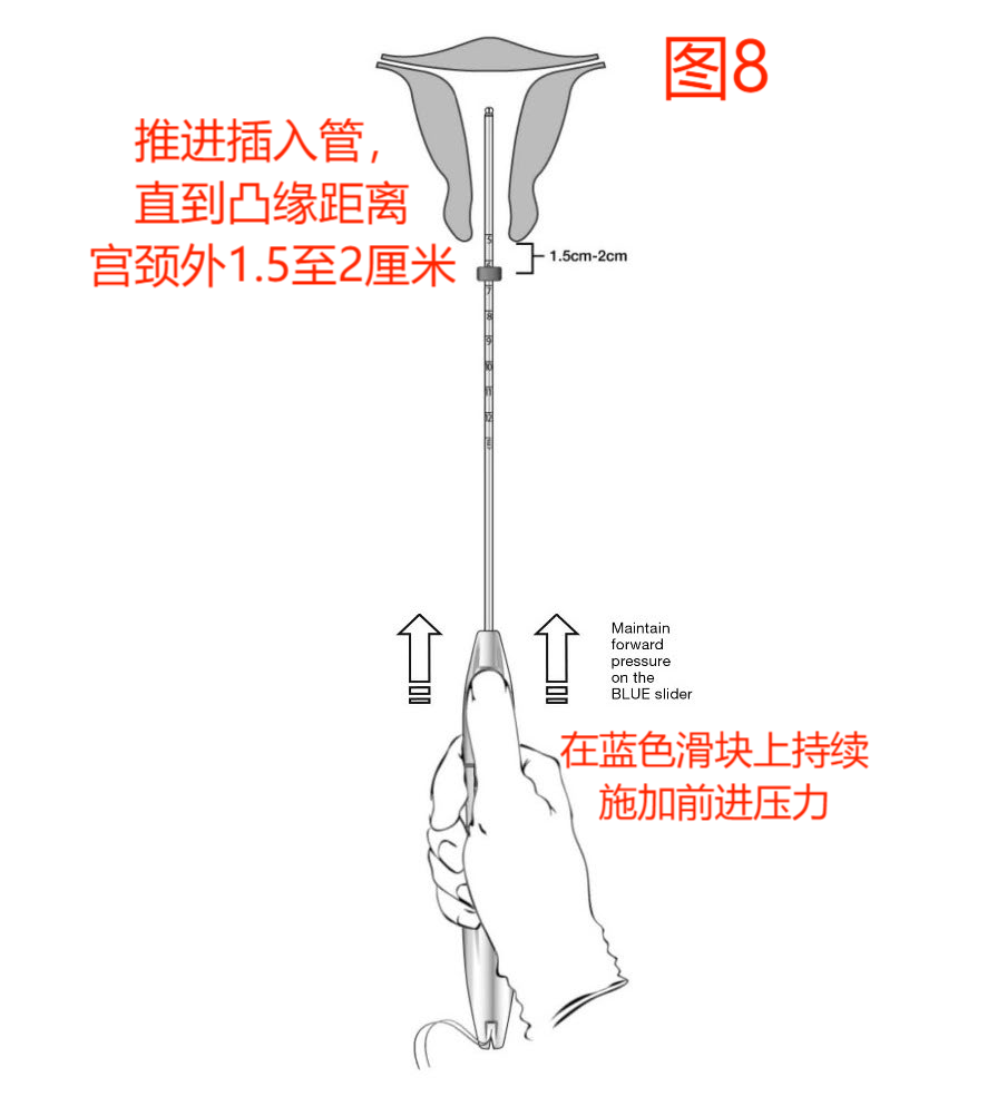 宫内节育器Liletta(图9)