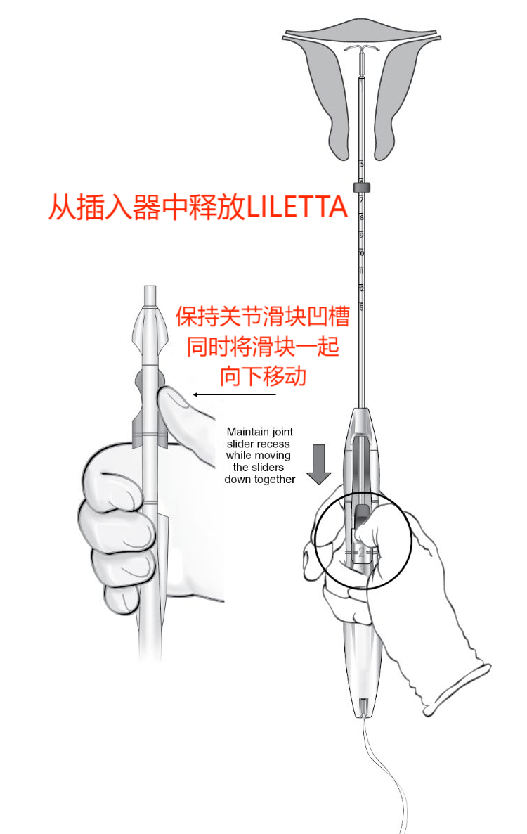 宫内节育器Liletta(图12)