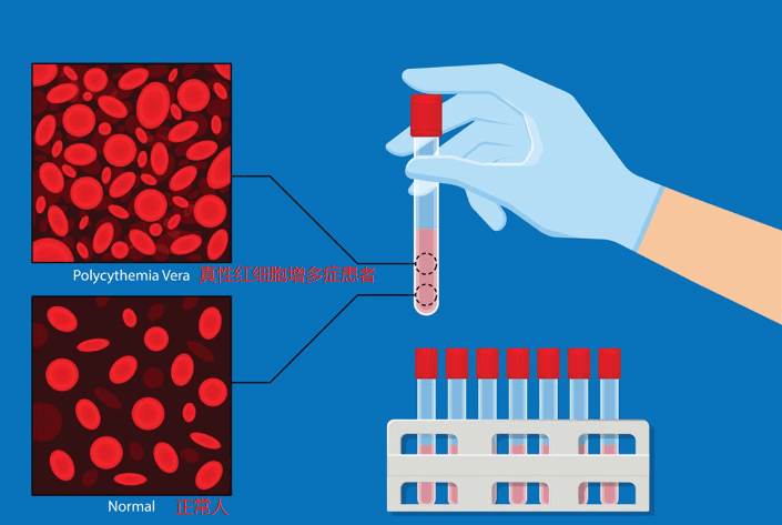 真性红细胞增多症示意图