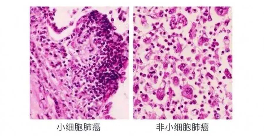 小细胞肺癌和非小细胞肺癌对比图_副本.jpg